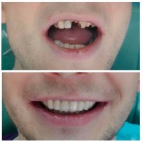 Професійне протезування зубів у місті Черкаси - пенсіонерам знижка